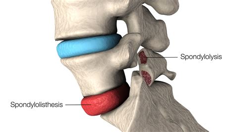 lumbar spondylolisthesis.